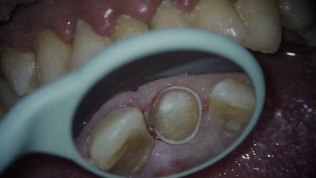 Подготовка зуба под керамическую коронку EMax на CEREC #стоматология #пломба #имплант #кариес