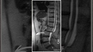 Межпозвоночная грыжа L2-L3 или  L3-L4! Ретролистез позвонк?