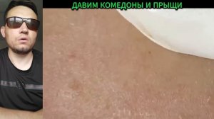 ДАВИМ комедоны и ПРЫЩИ №12
