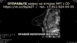 КИСТА молочной железы BI RADS 2 БОЛЯТ молочные железы  акс