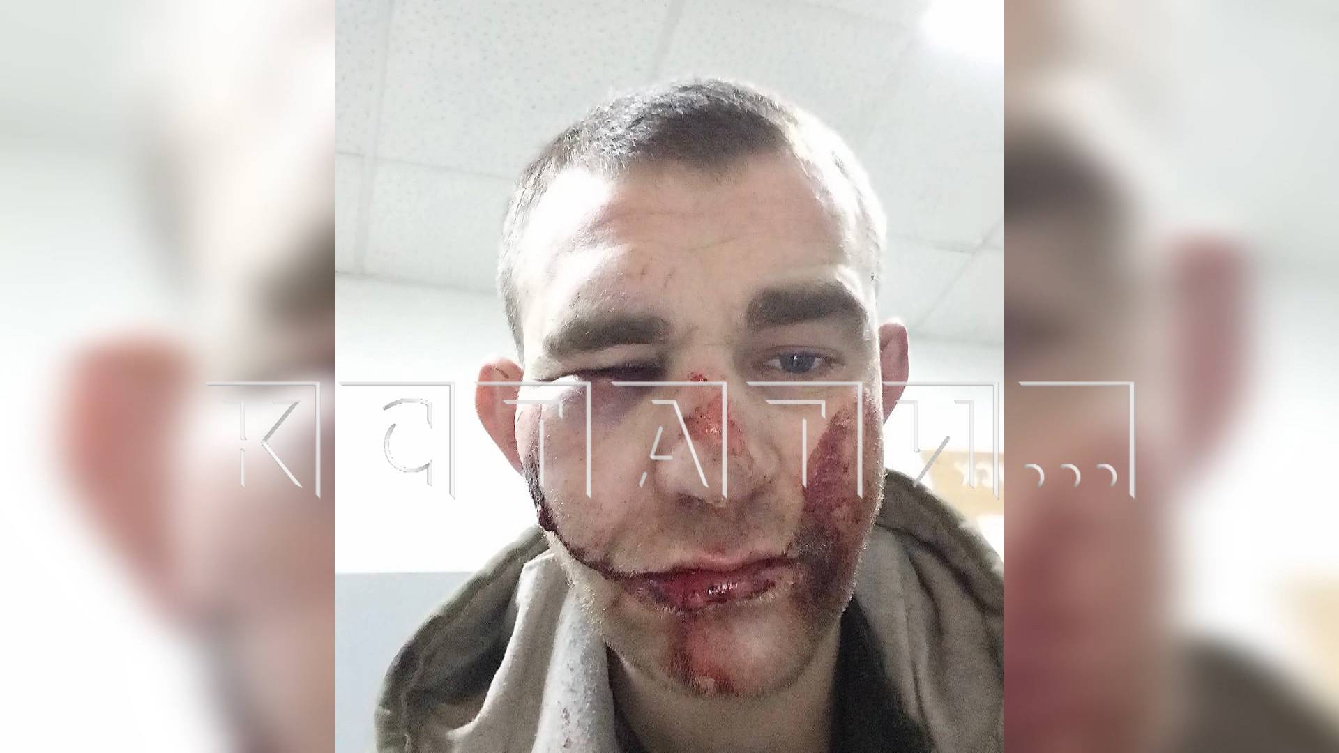 Пьяного мужчину, которого тёща сдала в полицию, чтобы проспался, избили до переломов костей лица