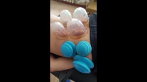Статическая постановка вакуумных банок