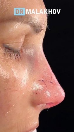 Вторичная риносептопластика 👃🏼
ДО и НА ОПЕРАЦИОННОМ столе