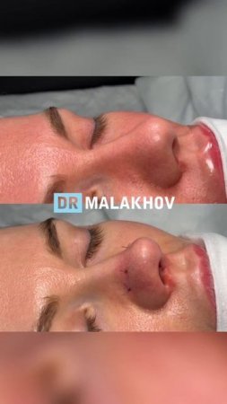 Первичная ринопластика 💡