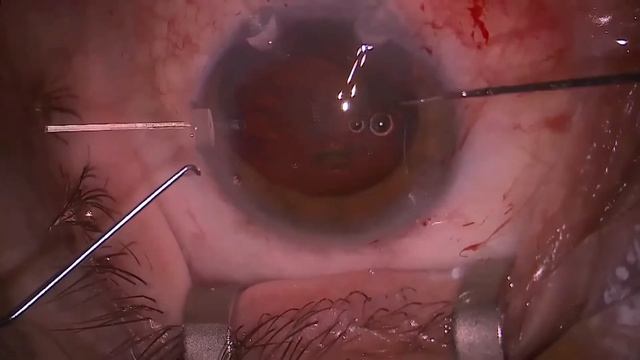 Катаракта+ подвывих - не … не слышали! смотреть онлайн