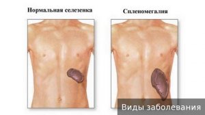 Спленомегалия. Как лечить спленомегалию.