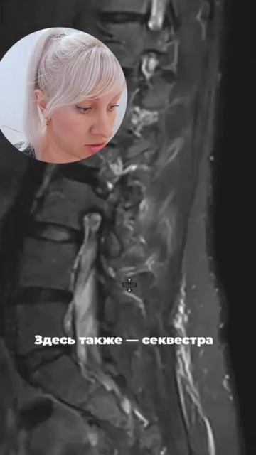 После лечения грыжи нет