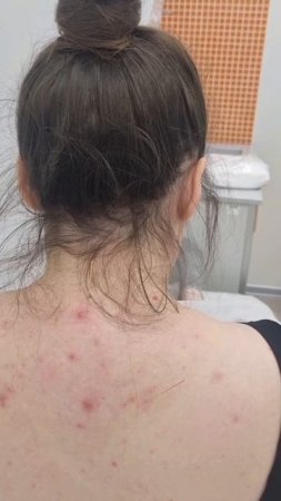 лечение нервных болезней методом рефлексотерапии