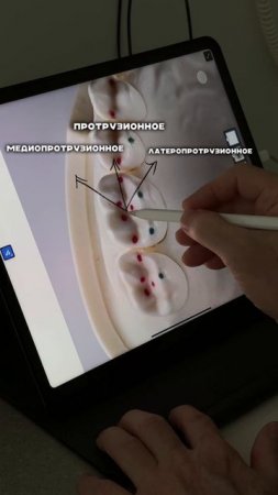 Про окклюзионные контактные движения