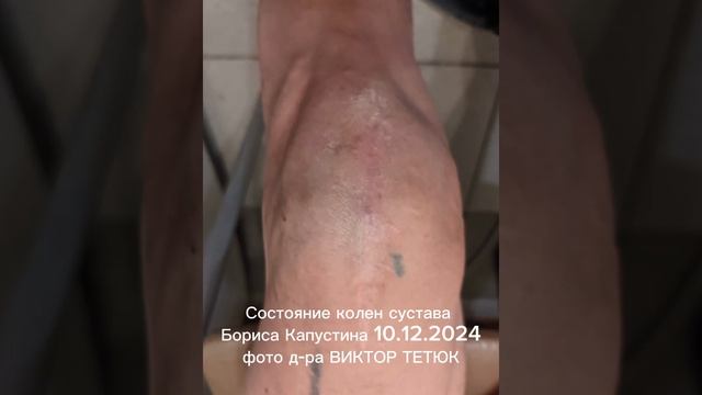 ♦️ШОКИРУЮЩИЙ РЕЗУЛЬТАТ. д-р ВИКТОР ТЕТЮК / БОРИС КАПУ? смотреть онлайн