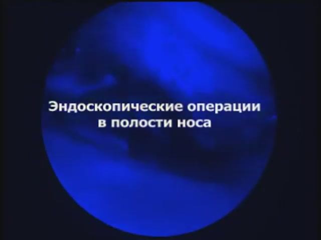 Эндоскопические операции в полости носа смотреть онлайн