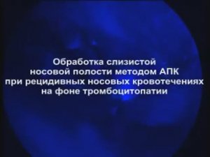 Обработка слизистой носовой полости методом АПК