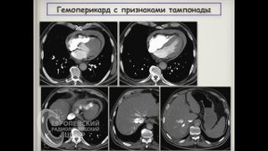 Часть 1. КТ при неотложных заболеваниях органов грудной полости. Андрей Мангов