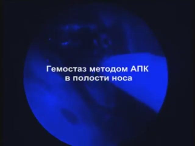 Гемостаз в полости носа методом АПК смотреть онлайн