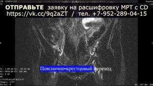 Двусторонний САКРОИЛЕИТ и признаки БОЛЕЗНИ БЕХТЕРЕВА