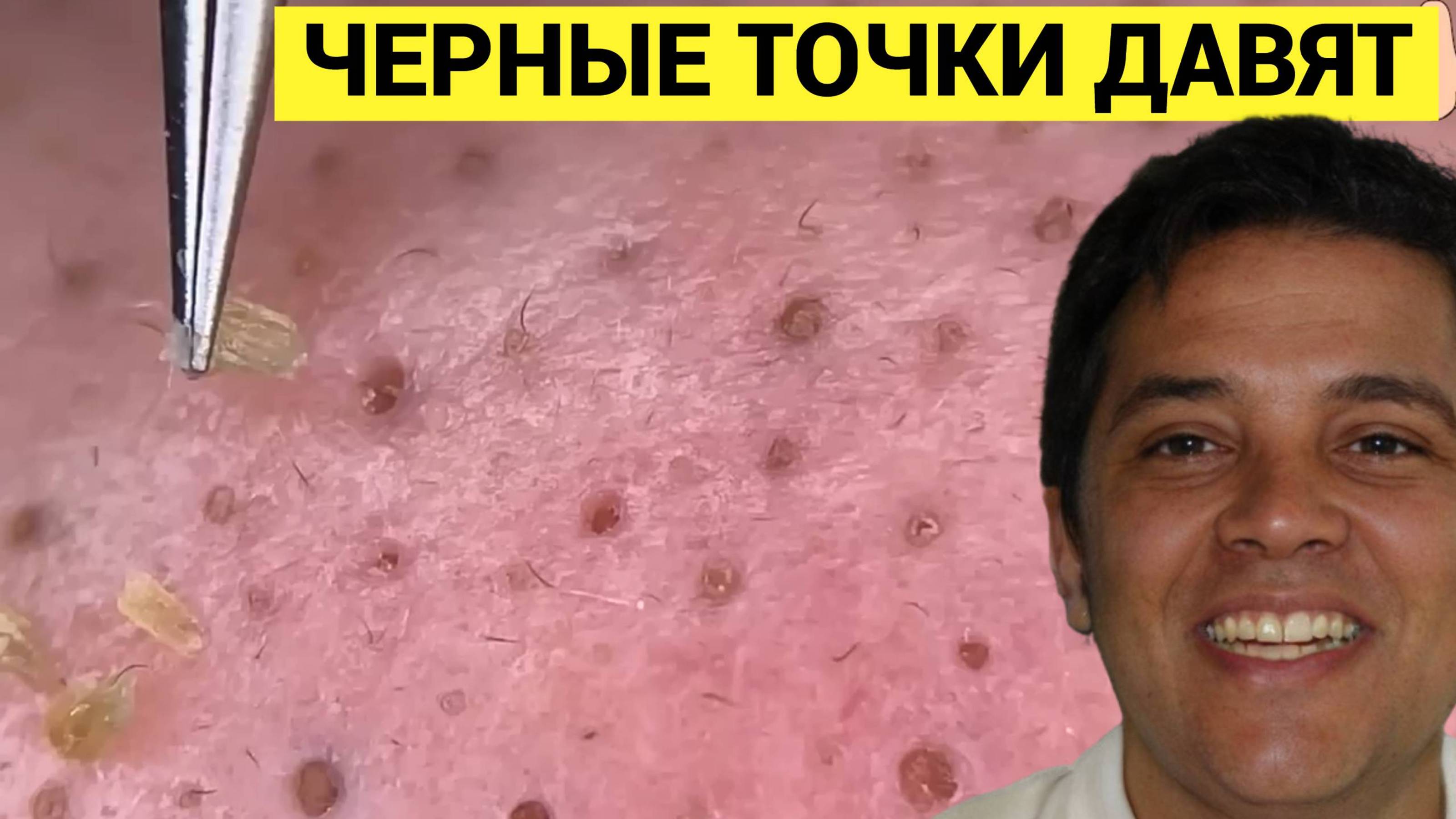 Черные Точки в Носу ПЕЩЕРЫ Оставили, вот ТАК ДЕЛА