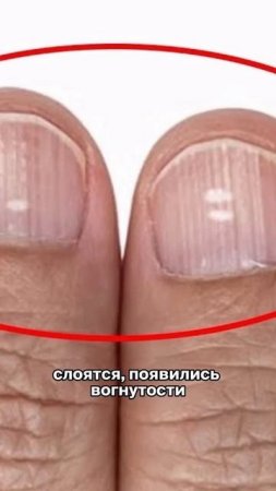 Как определить ЖЕЛЕЗОДЕФИЦИТ без анализов?