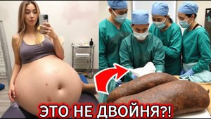 ОНА ЖДАЛА БЛИЗНЕЦОВ, НО… ЭТОГО НЕ ОЖИДАЛ НИКТО!