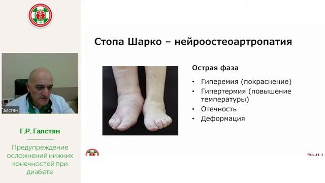 Предупреждение осложнений нижних конечностей при диабете