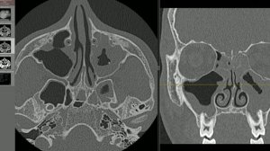 Околоносовые пазухи на КТ. Туториал для начинающих