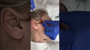 Нитевой лифтинг лица как часто делать? #косметолог #ни?