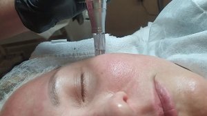 МИКРОНИДЛИНГ ЛИЦА. #микронидлинг #мезотерапия #космет?