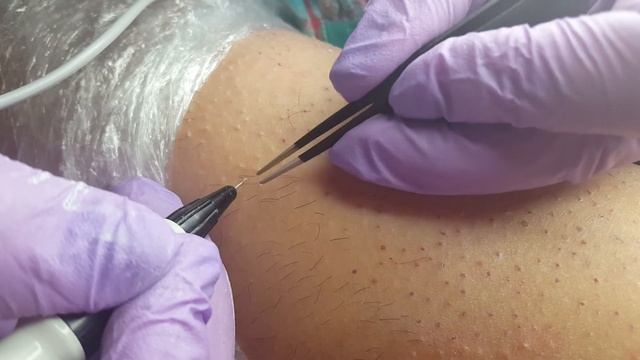 ЭЛЕКТРОЭПИЛЯ голень. смотреть онлайн