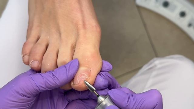 В этом видео не только обработка онихолиза, но и спосо? смотреть онлайн