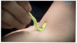 Первая помощь при укусе клеща