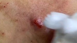 ASMR Релаксация. Выдавливание угрей и черных точек.