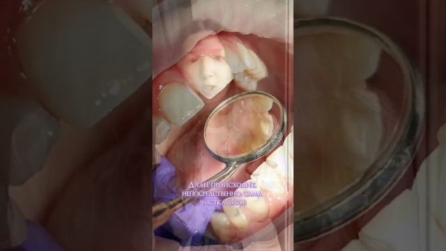 Что такое профессиональная гигиена полости рта (профессиональная чистка зубов), кто еë делает, этап