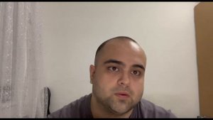 Миноксидил и финастерид 7 месяцев до/после