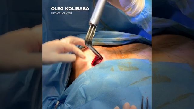 Техника увеличения груди Dual Plane / Dual Plane Breast Augmentation Technique смотреть онлайн