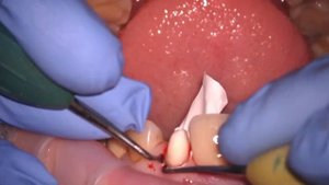 Протокол фиксации циркониевых коронок