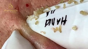 Выдавливание черных точек и прыщей 2023 Blackhead Extraction My Favor