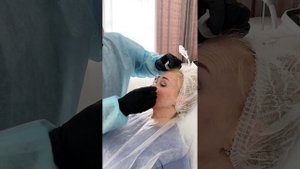Коррекция ботулотоксином межбровной морщины.