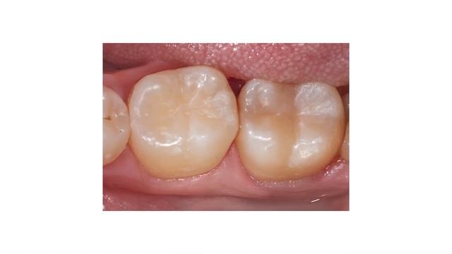 Как избавиться от чувствительности зубов? 5 эффективн? смотреть онлайн