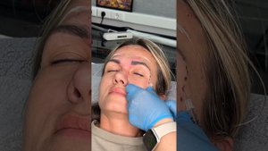 Botox. Ботулинотерапия по технике доктора Асель Салимов?