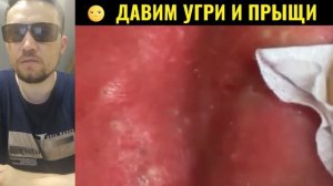 МЕХАНИЧЕСКАЯ чистка крупным планом №21