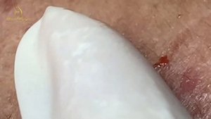 Выдавливание черных точек и прыщей 2023 Blackhead Extraction How to D