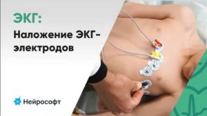 Быстрое наложение ЭКГ-электродов