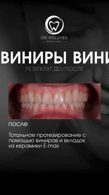 Преображение улыбки с помощью виниров E.max 🦷
