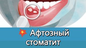💥 Афтозный стоматит