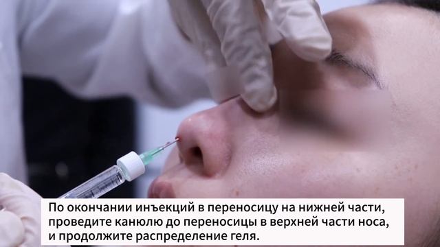 Техника инъекционной мезотерапии коррекция носа при ?