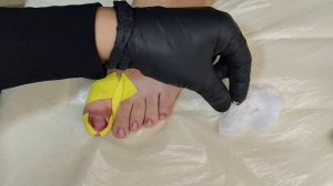 Tirnoq et ichiga o'sishi, davosi (лечение вросшего ногтя)