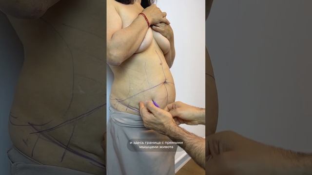 КОМПЛЕКСНАЯ АБДОМИНОПЛАСТИКА. Доктор Карапетян