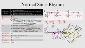 33.Normal Sinus Rhythm