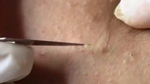 Black dots, clogged pores, thorough cleansing. Черные точки, закупоренные п