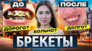 БРЕКЕТЫ сколько стоят МОЯ ИСТОРИЯ до и после