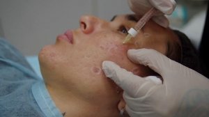 Сепарация постакне Видео-Урок | Обучение техникам